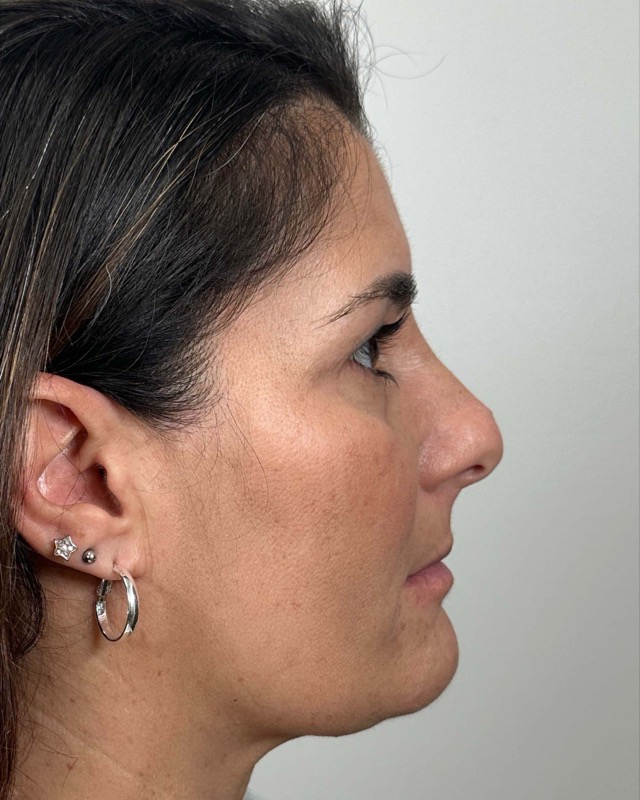 Juvederm Before & After Image