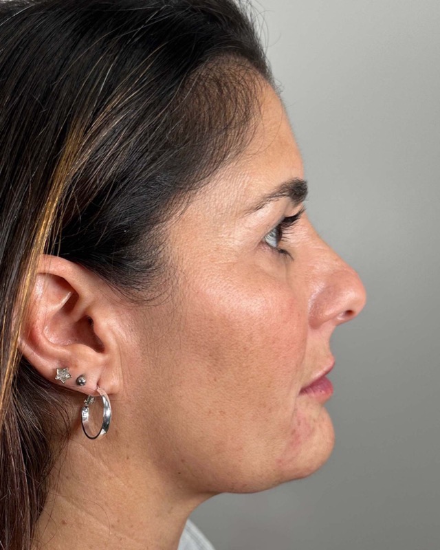 Juvederm Before & After Image