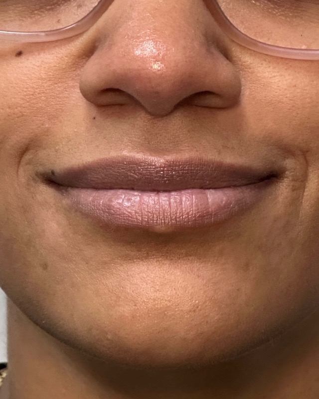 Juvederm Before & After Image