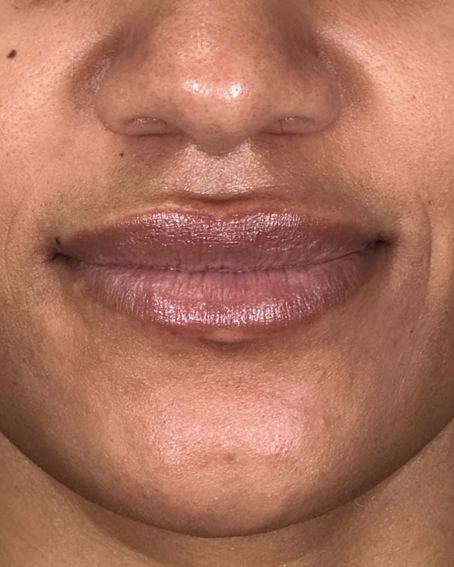 Juvederm Before & After Image