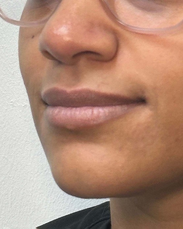 Juvederm Before & After Image