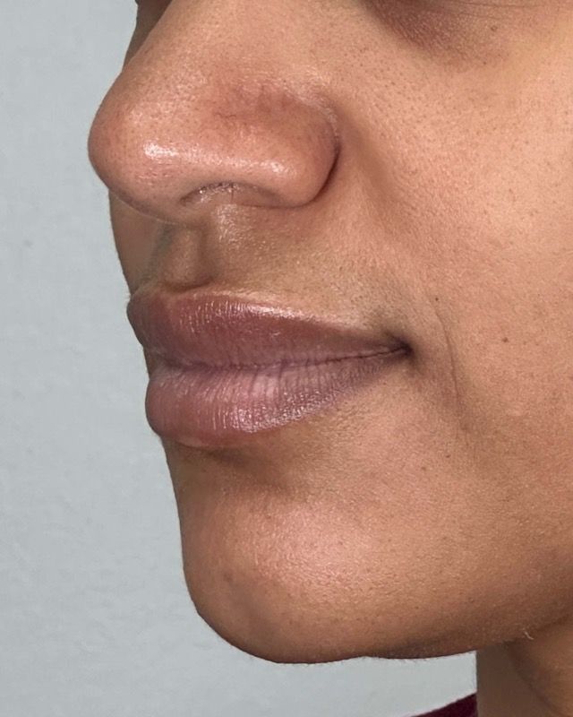 Juvederm Before & After Image