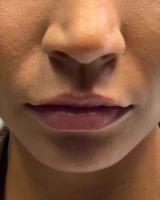Juvederm Before & After Image