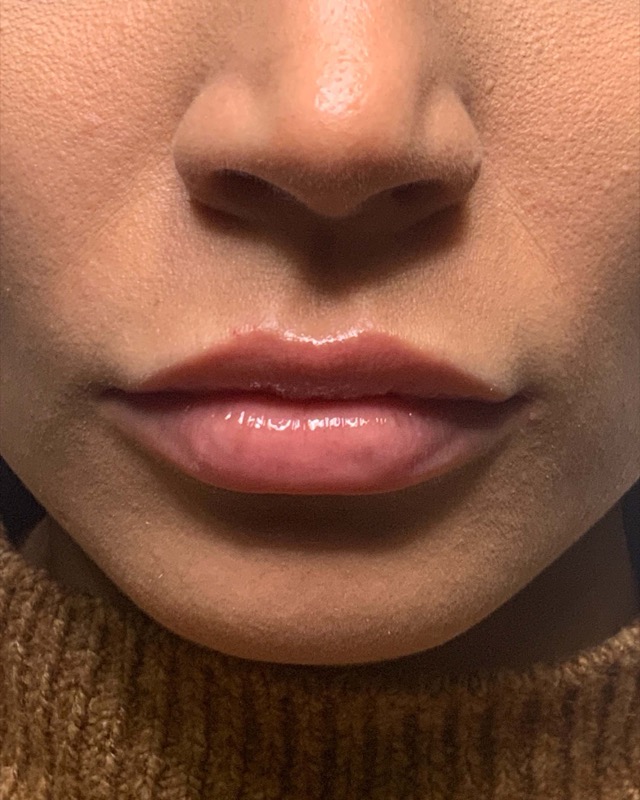 Juvederm Before & After Image