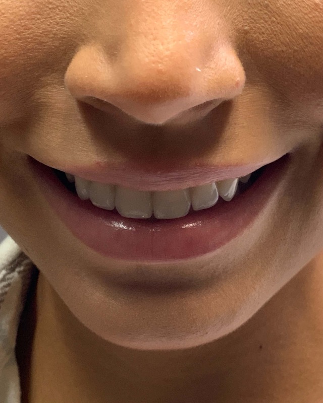 Juvederm Before & After Image