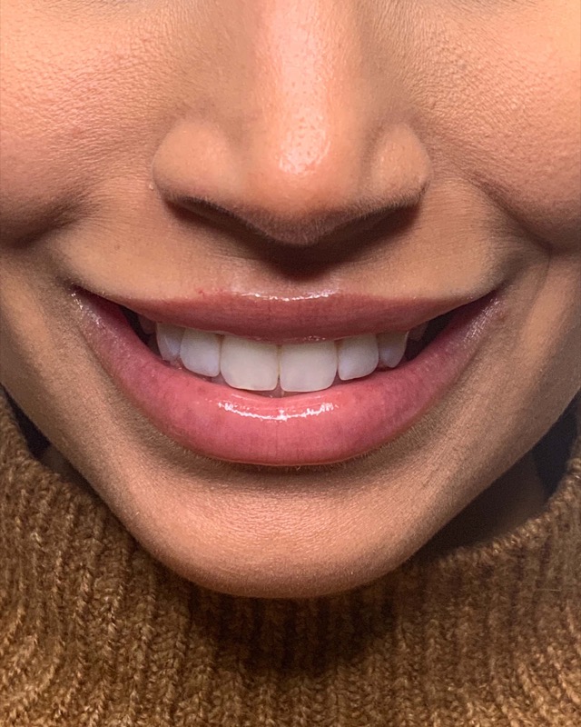 Juvederm Before & After Image