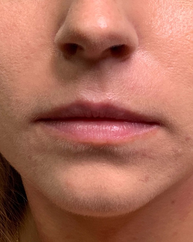 Juvederm Before & After Image