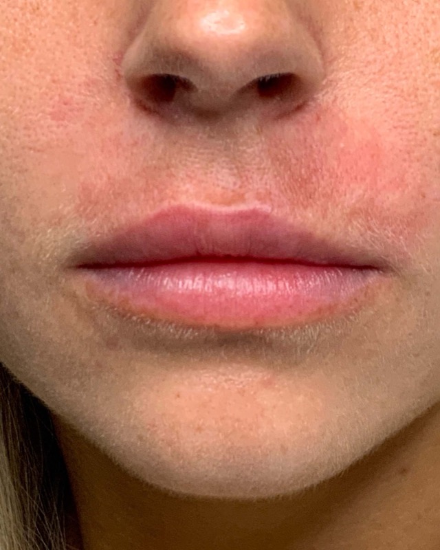 Juvederm Before & After Image