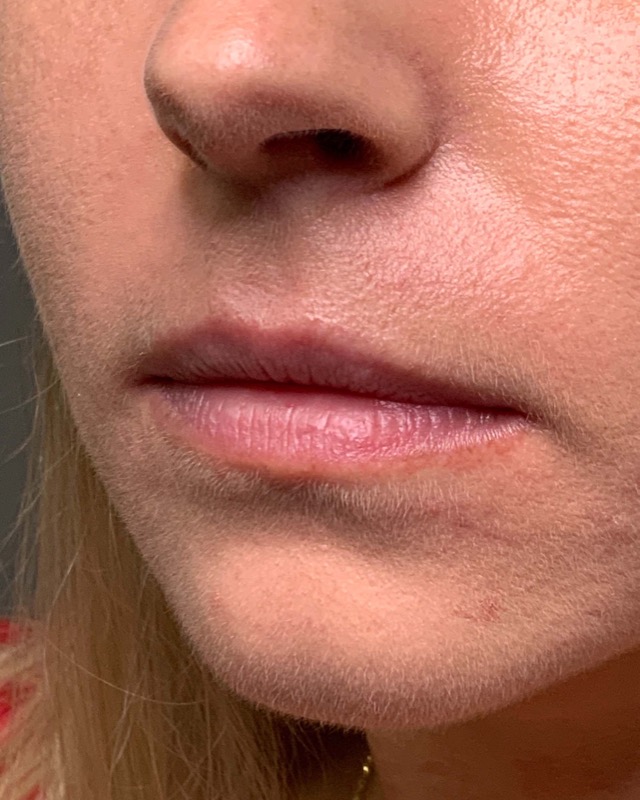Juvederm Before & After Image