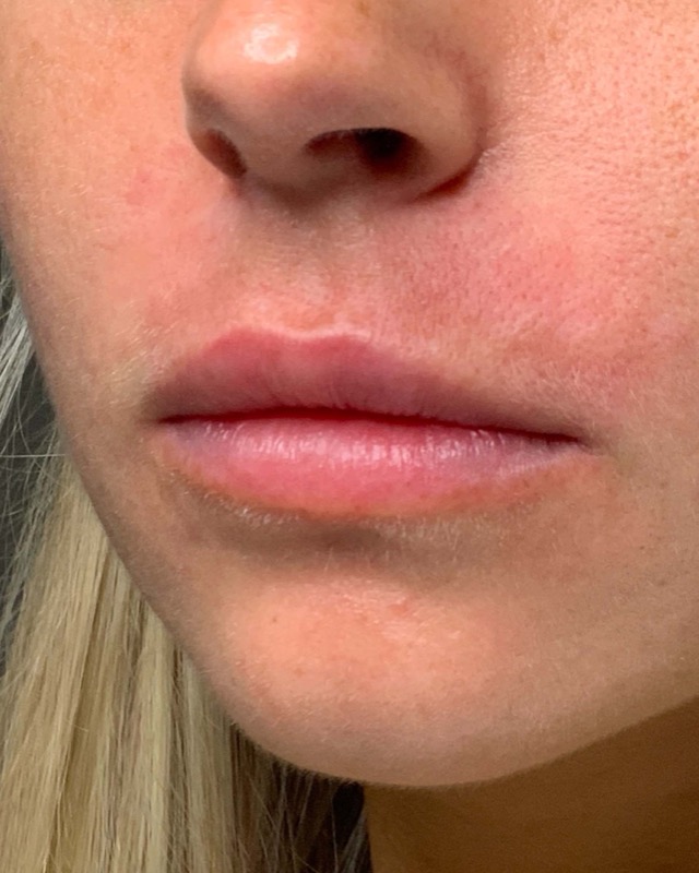 Juvederm Before & After Image