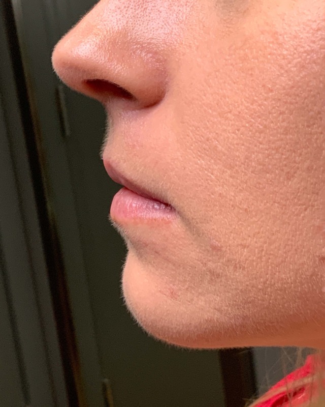 Juvederm Before & After Image