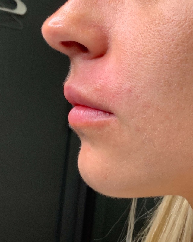 Juvederm Before & After Image