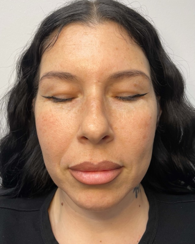 Juvederm Before & After Image