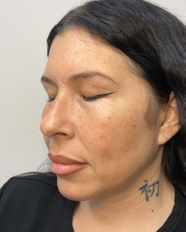 Juvederm Before & After Image