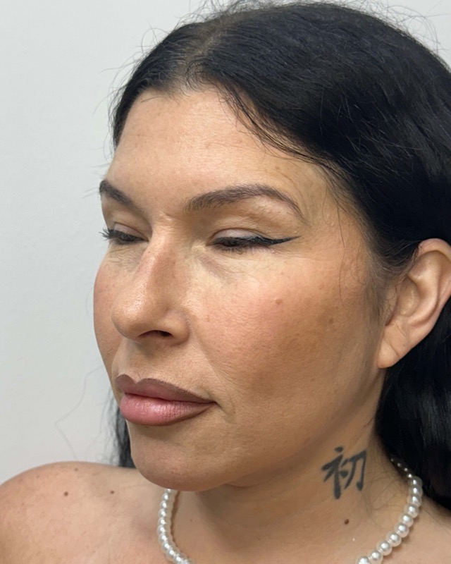 Juvederm Before & After Image