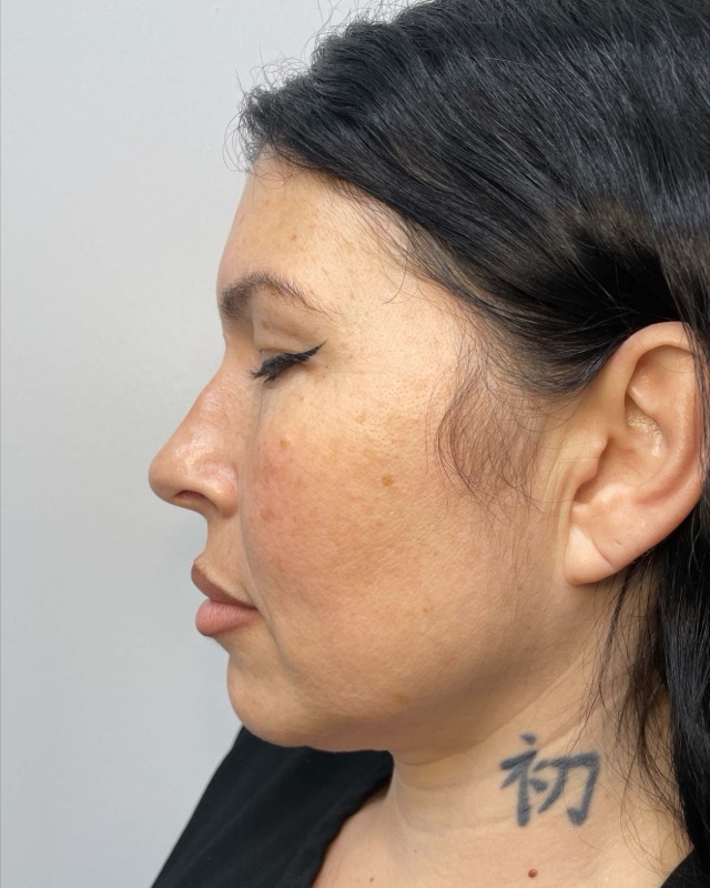 Juvederm Before & After Image