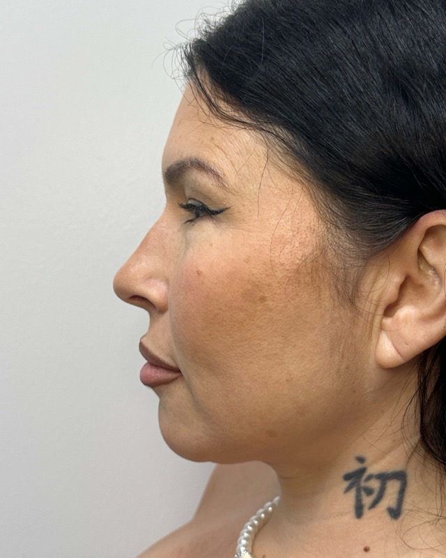 Juvederm Before & After Image