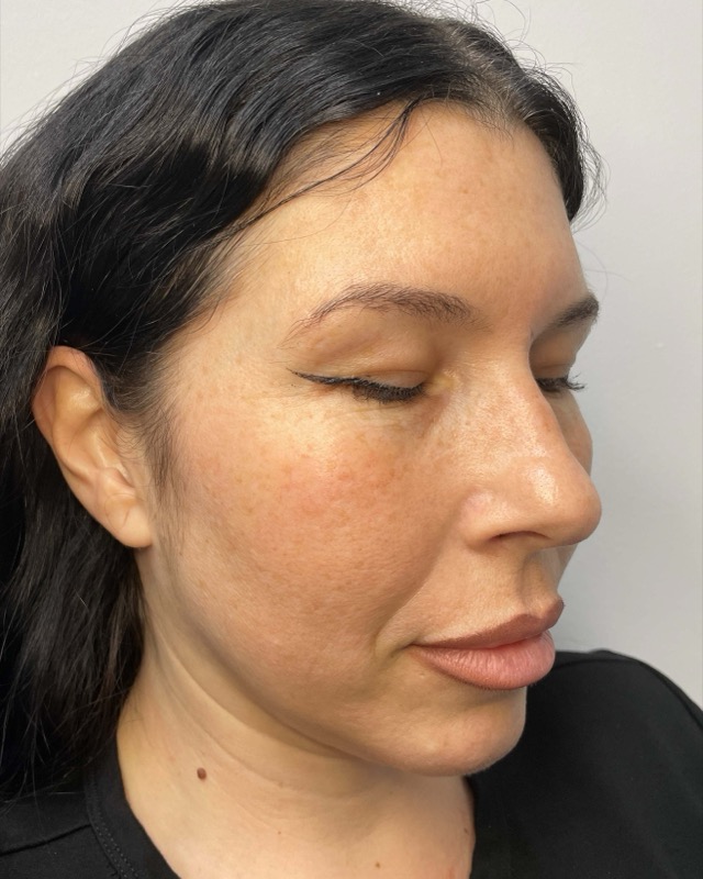 Juvederm Before & After Image