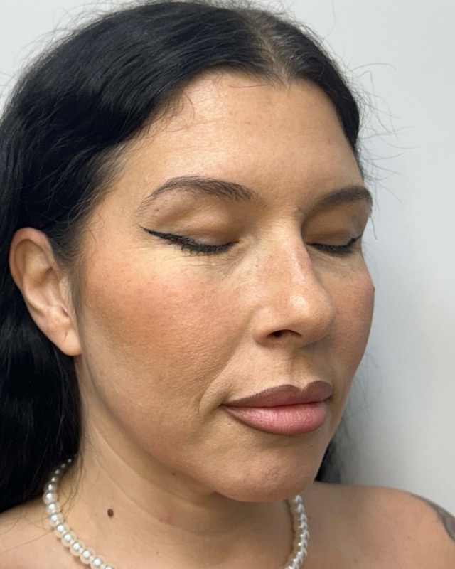 Juvederm Before & After Image