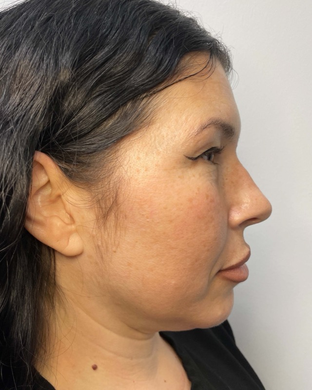 Juvederm Before & After Image