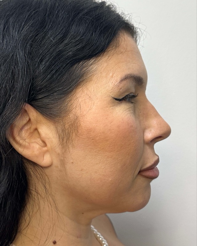 Juvederm Before & After Image