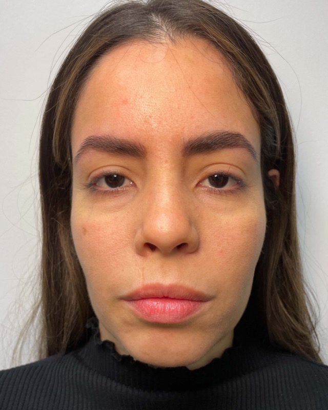 Juvederm Before & After Image