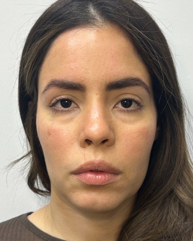 Juvederm Before & After Image