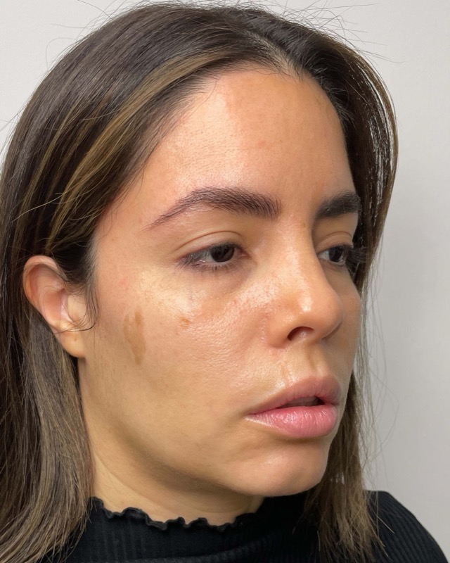 Juvederm Before & After Image