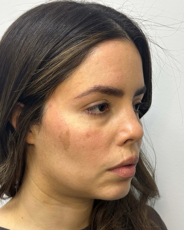 Juvederm Before & After Image