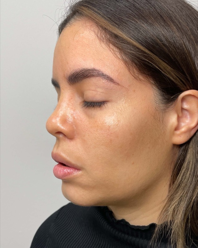 Juvederm Before & After Image