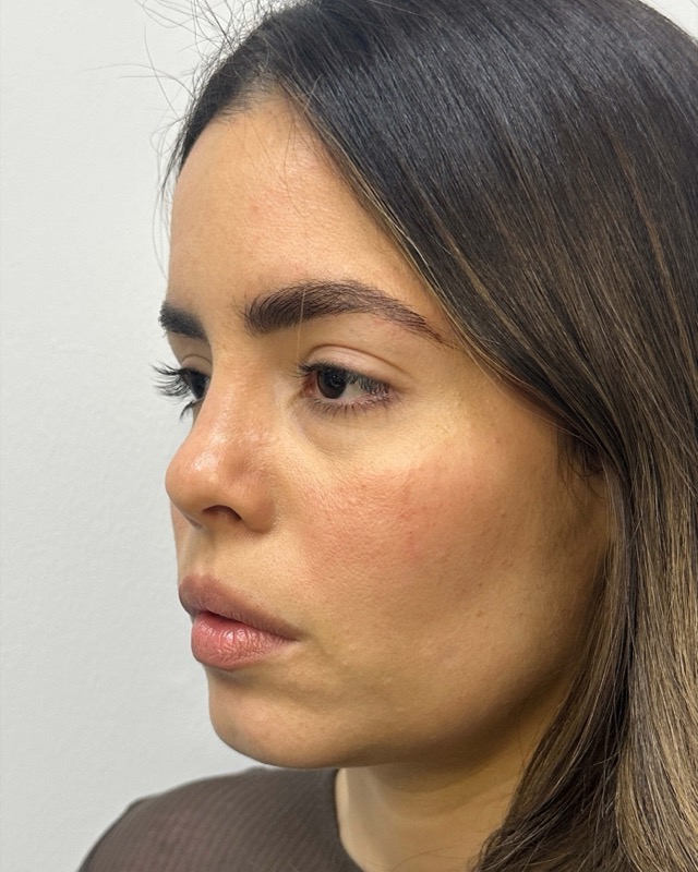 Juvederm Before & After Image
