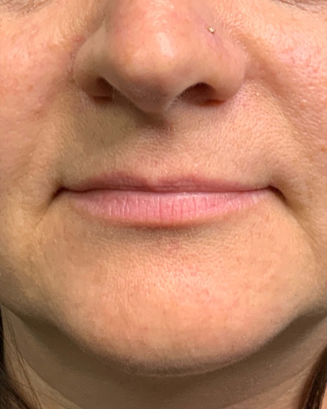 Juvederm Before & After Image