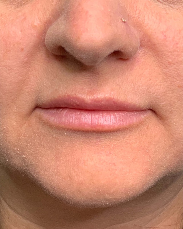 Juvederm Before & After Image