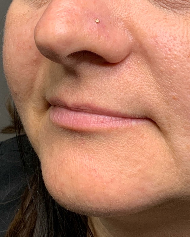 Juvederm Before & After Image