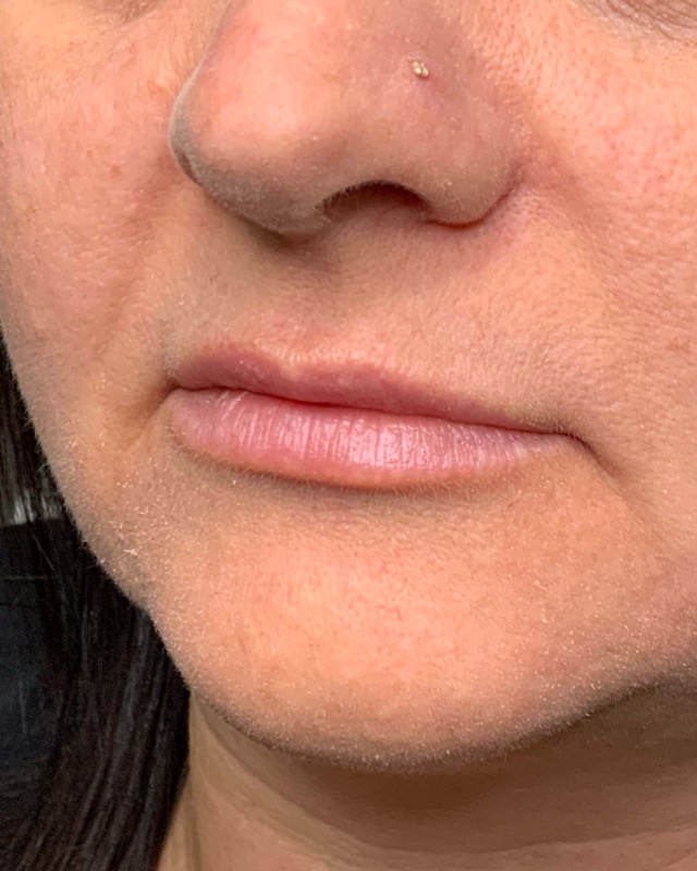Juvederm Before & After Image