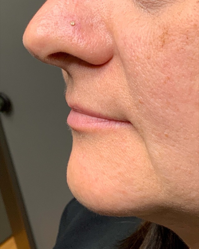 Juvederm Before & After Image