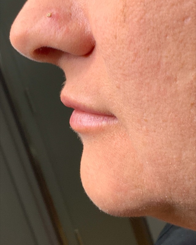 Juvederm Before & After Image