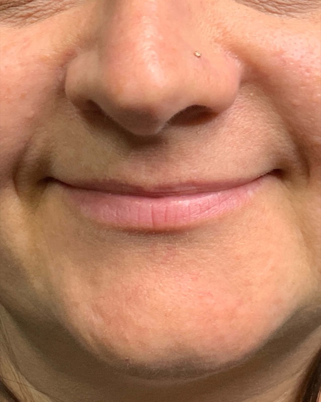 Juvederm Before & After Image