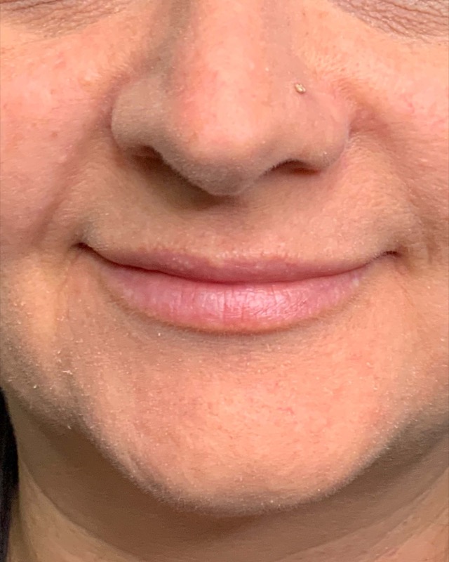 Juvederm Before & After Image