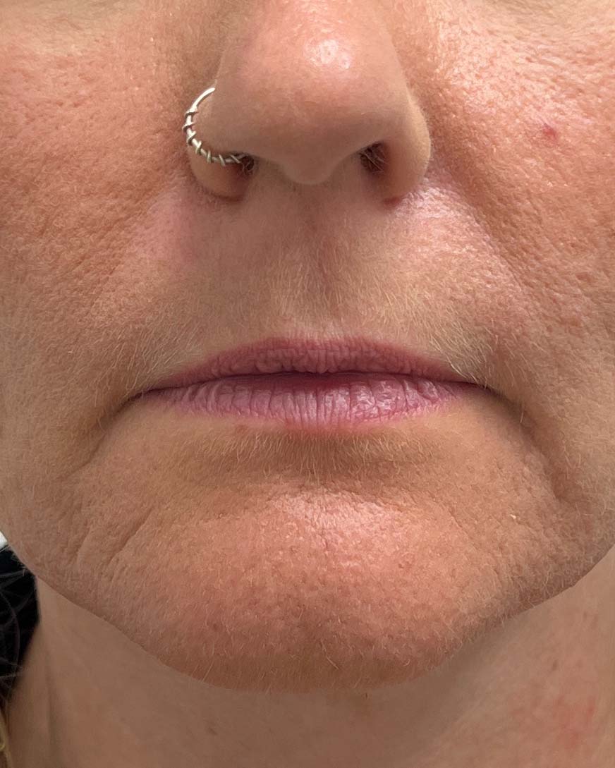Juvederm Before & After Image