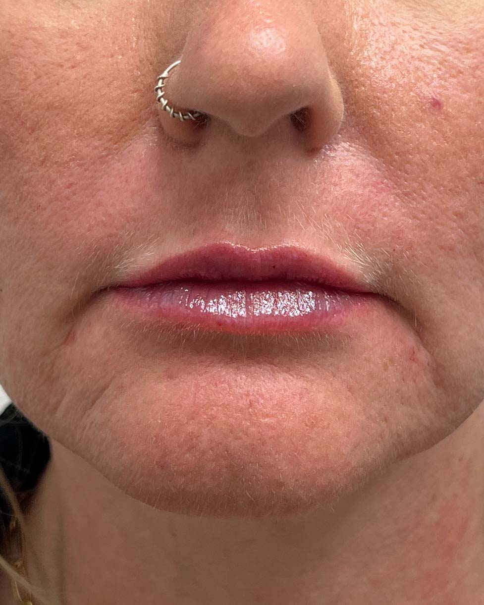 Juvederm Before & After Image