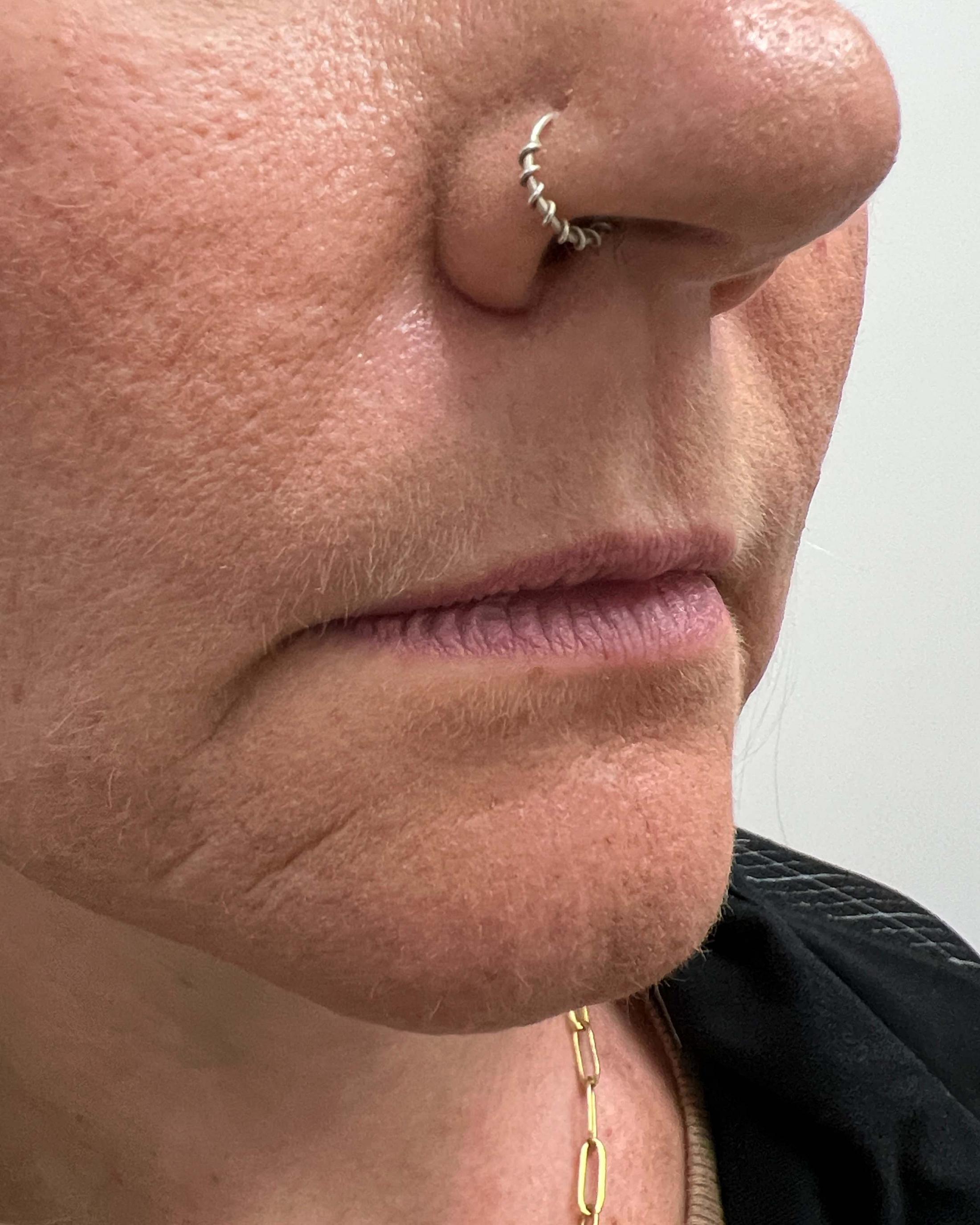 Juvederm Before & After Image