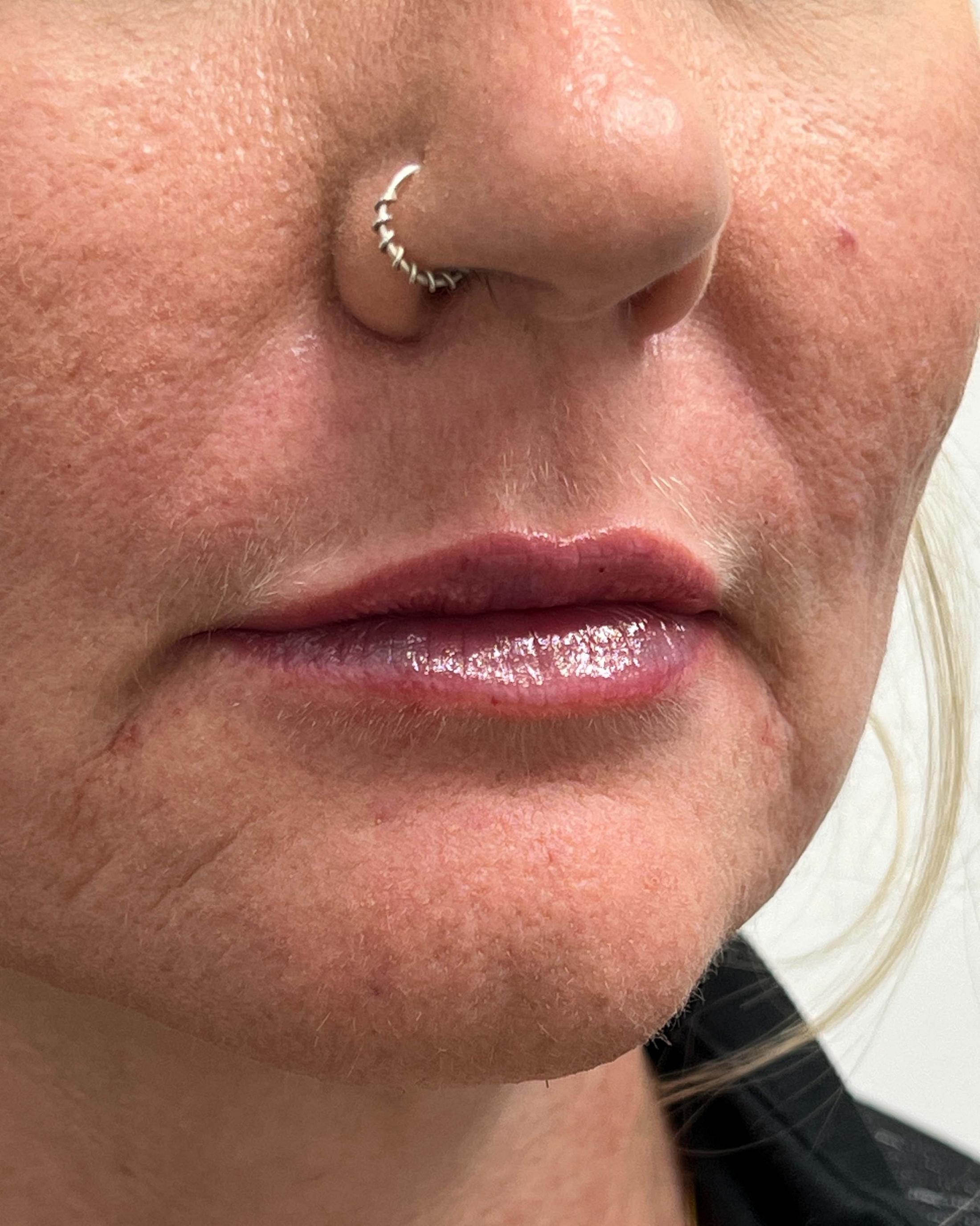 Juvederm Before & After Image