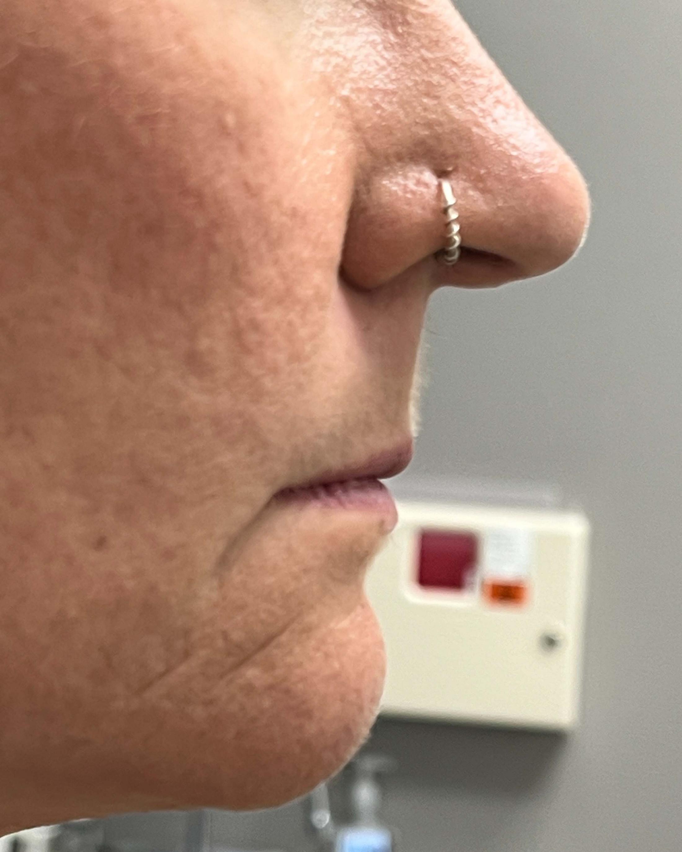 Juvederm Before & After Image