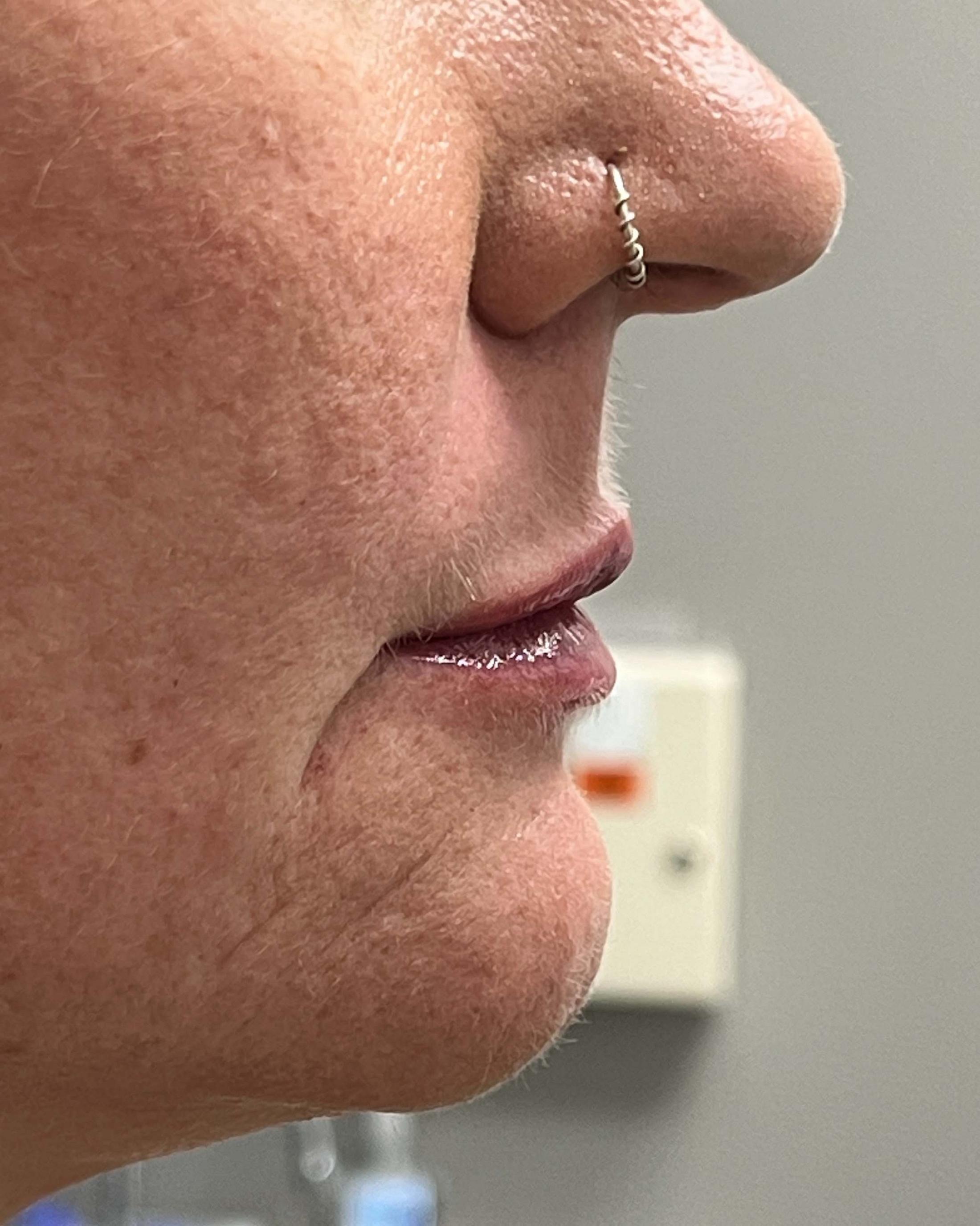 Juvederm Before & After Image