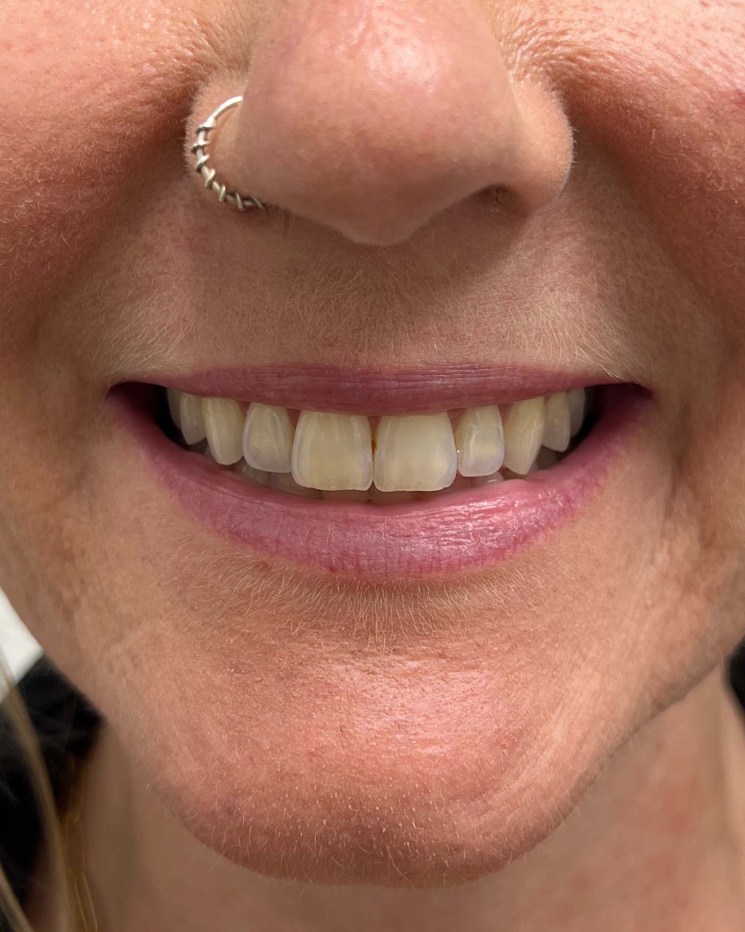 Juvederm Before & After Image