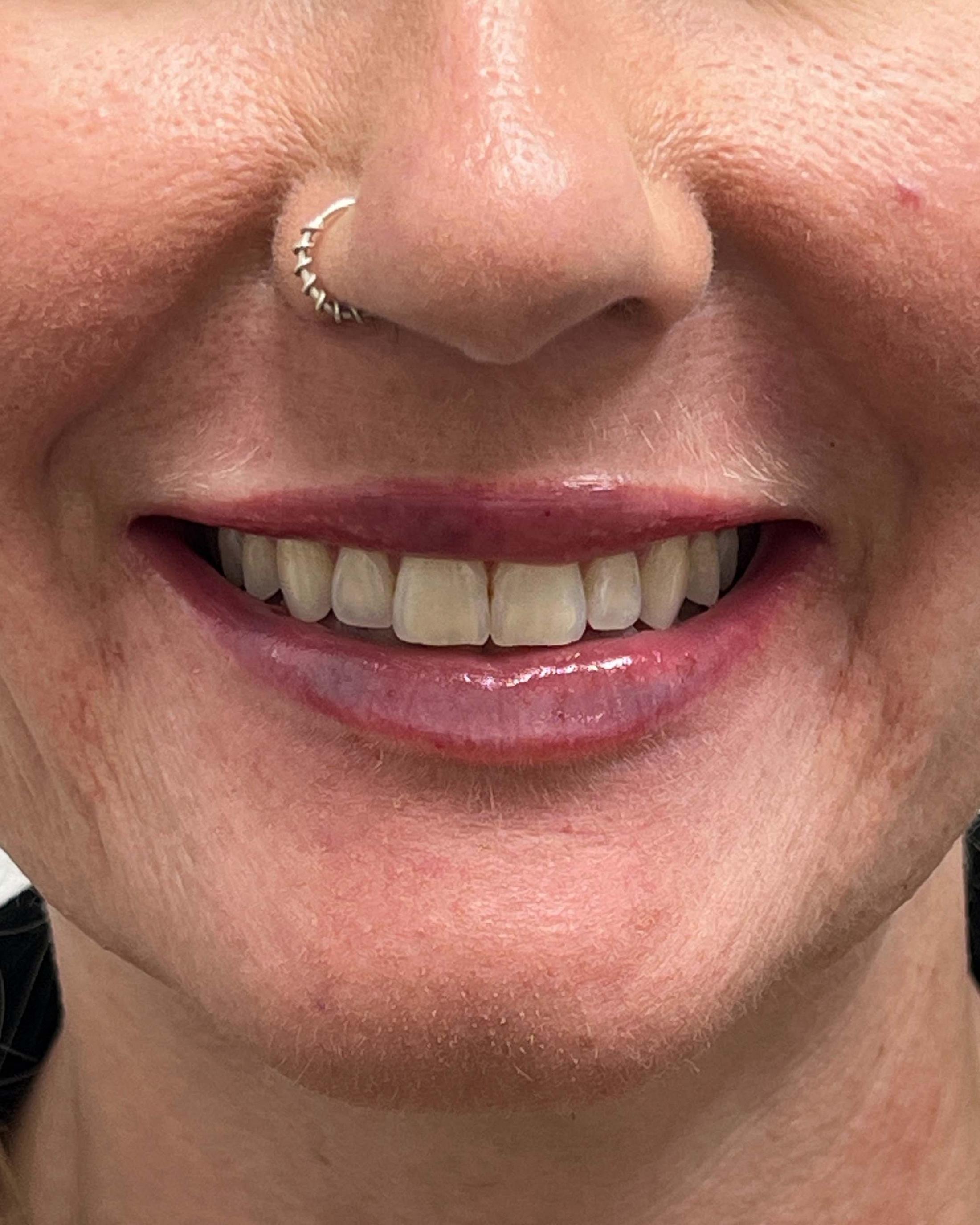 Juvederm Before & After Image