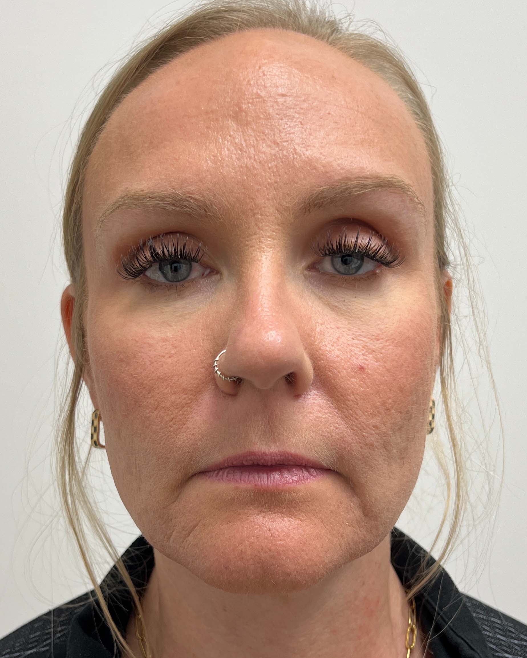 Juvederm Before & After Image