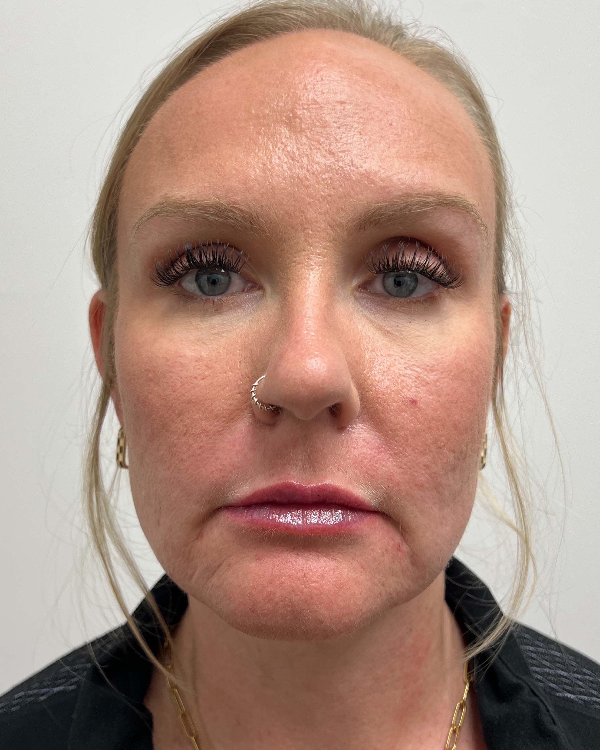 Juvederm Before & After Image