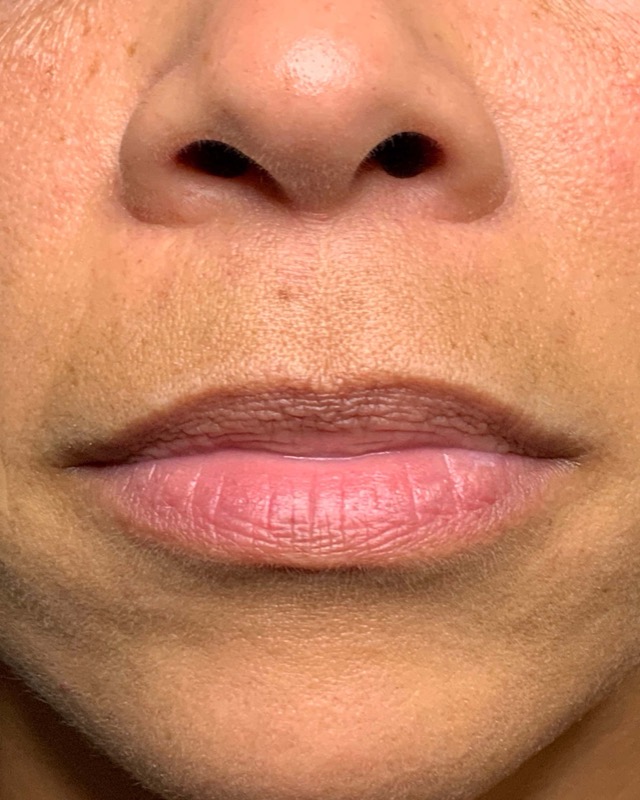 Juvederm Before & After Image